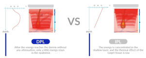Will DPL be Better Than IPL for Skin Treatment? - PZLASER