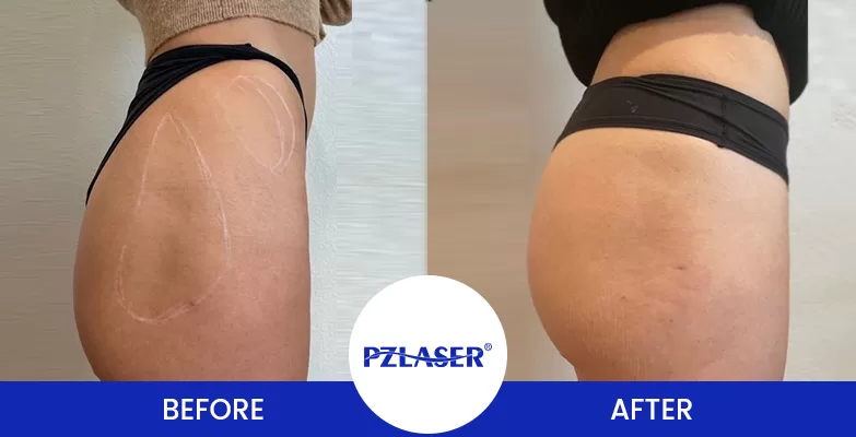 Non-Invasive Body Contouring for butt lift before and after