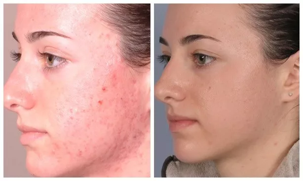 Resurfacing & Skin Texture Improvement laser treatment before and after