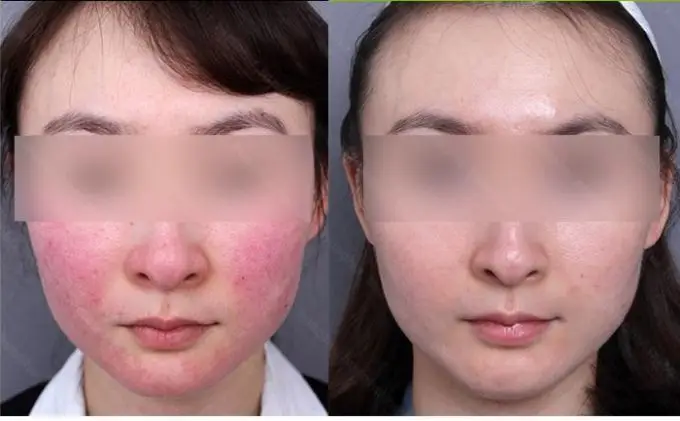 Vascular lasers treatment before and after