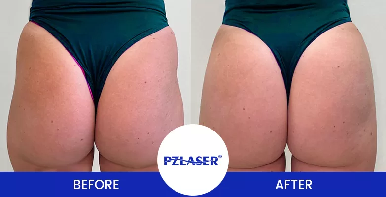 Brazilian Butt Lift(bbl) treatment before and after