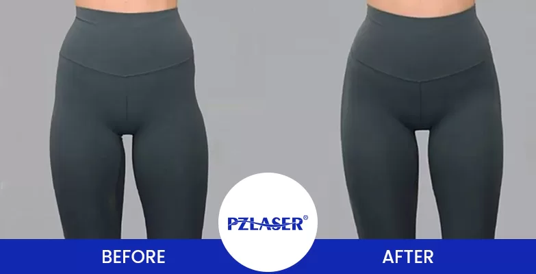 exercise for hip dips before and after