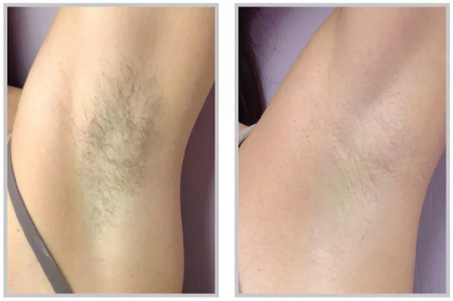 hair removal laser treatment before and after