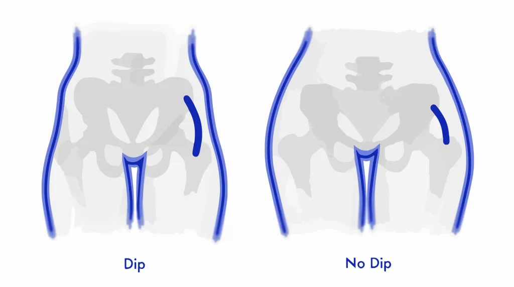 hip dip vs no dip