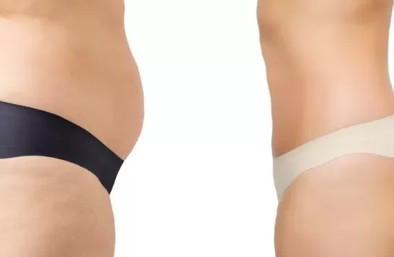 Body Contouring treatment before and after