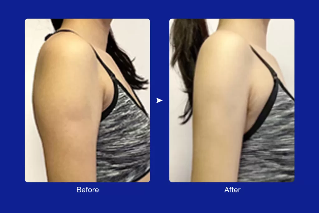 real cryo slimming arm before and after review