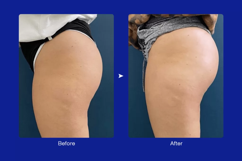 real cryo slimming buttocks before and after review