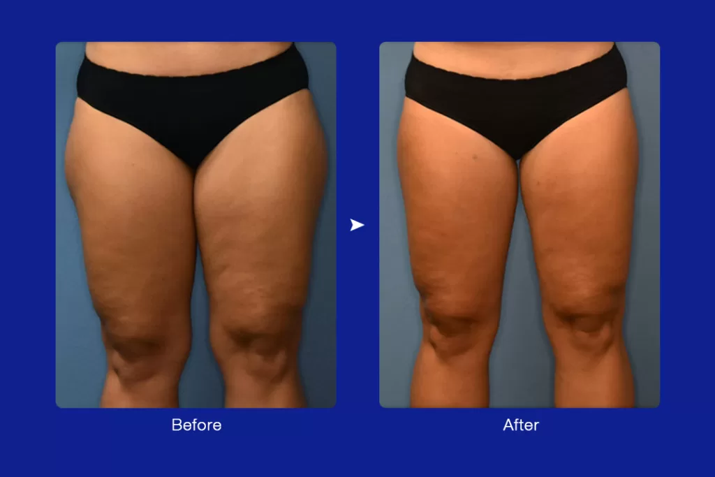 real cryo slimming thigh before and after review