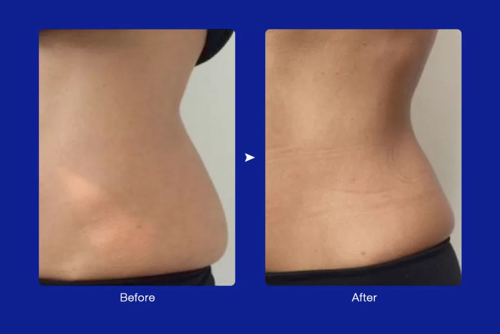 real cryo slimming waist before and after review