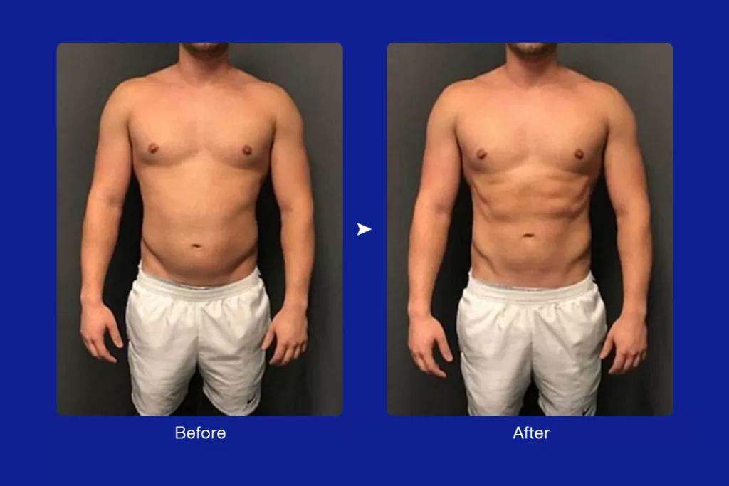 A man's belly fat burning before and after picture after sessions of electromagnetic muscle stimulation machine treatment