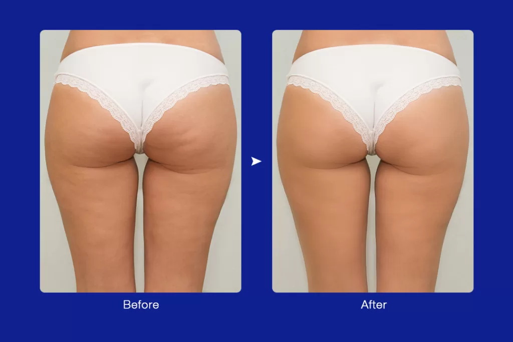 endospheres therapy on thighs for cellulite reduction before and after
