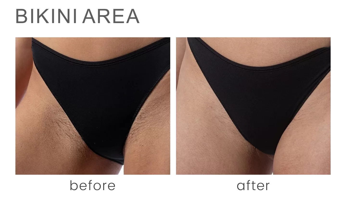 full brazilian laser hair removal before and after photos.