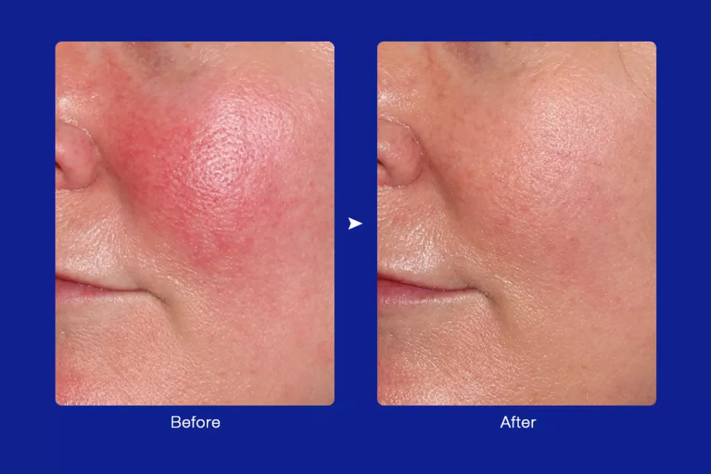 ultrasonic facial for skin redness before and after
