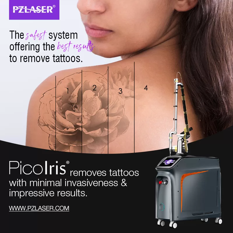 PicoIris® laser tattoo removal machine