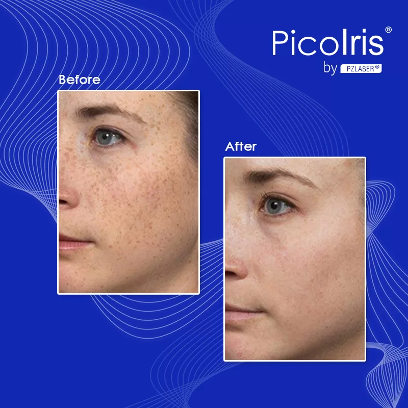 how can I remove freckles? The spa machine is PicoIris.