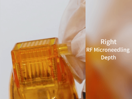 Is deeper microneedling better?How deep can RF microneedling go?