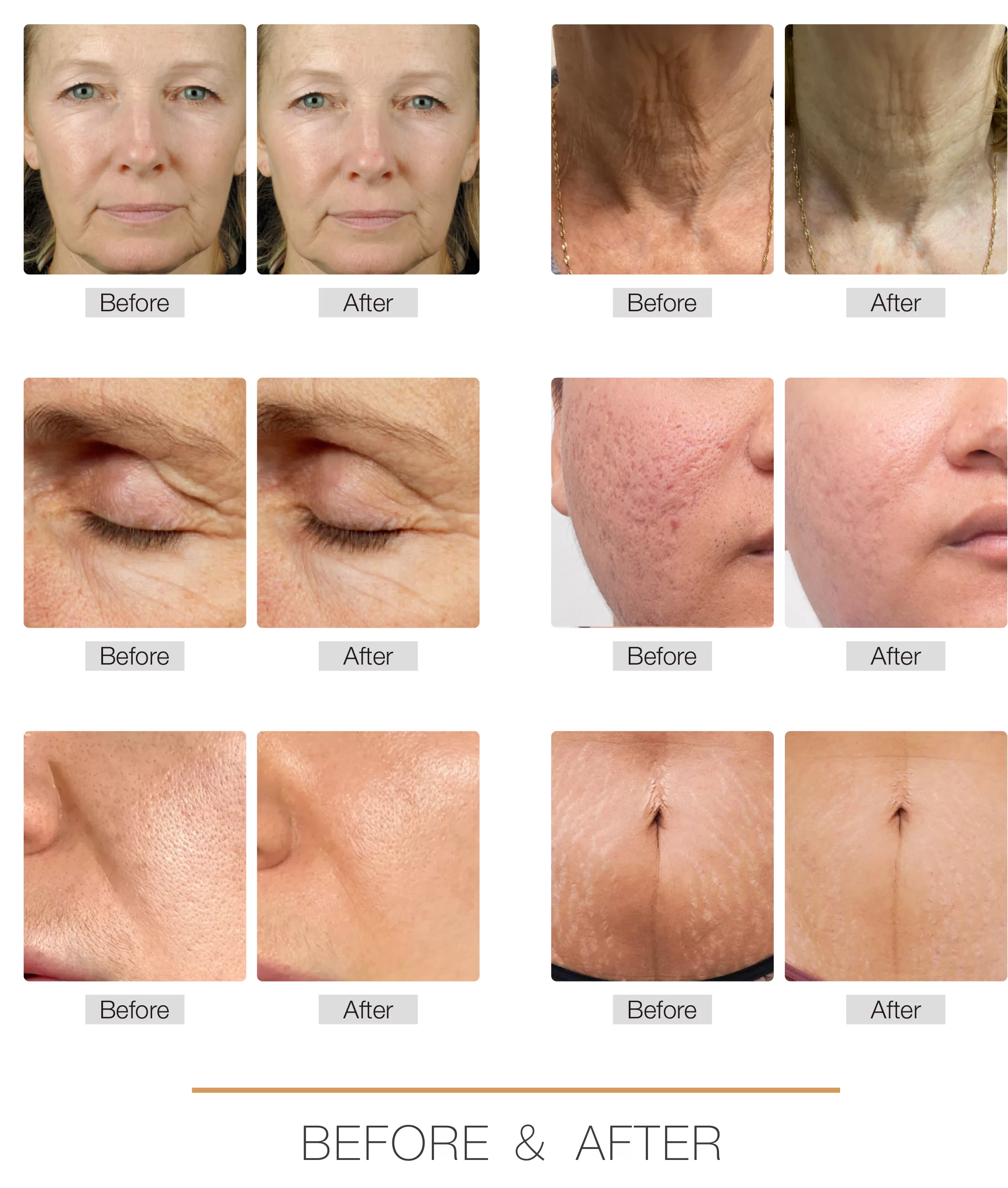 RF Microneedling treatment before and after