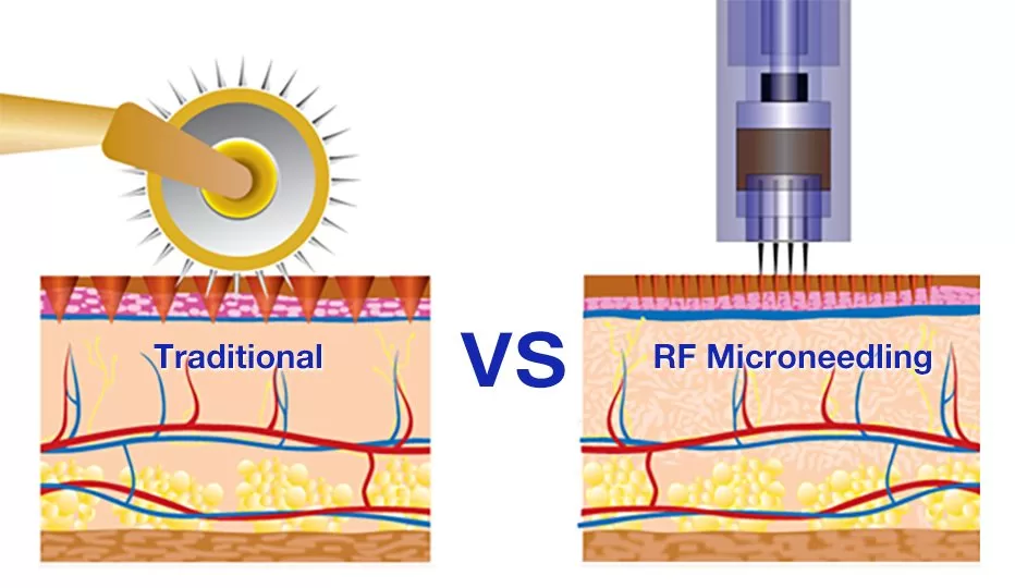 Traditional Microneedling: Accessible Yet Limited
RF Microneedling: Precision and Versatility