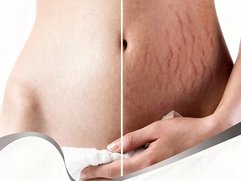 As stretch marks—medically known as striae distensae.