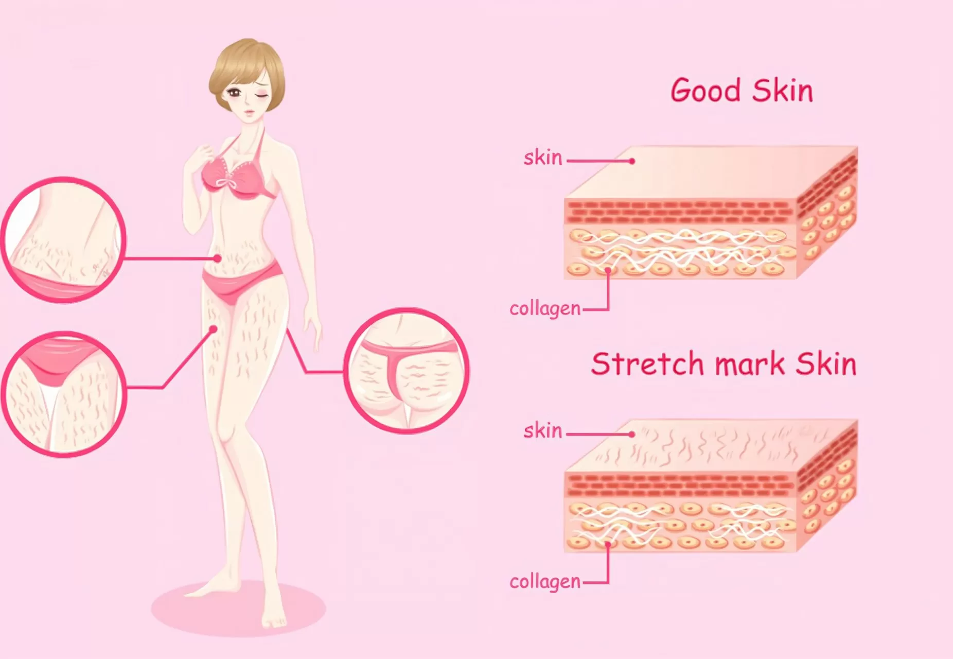 Good Skin vs Stretch Mark skin