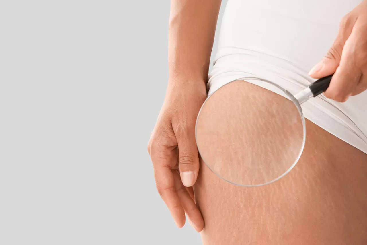 laser stretch mark removal delivers the most consistent and dramatic results, making it the preferred solution for modern clinics and spas.