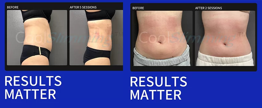 Before and after comparison of sub-zero fat freezing treatment