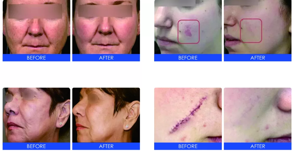 CO2 laser before and after Acne scar
