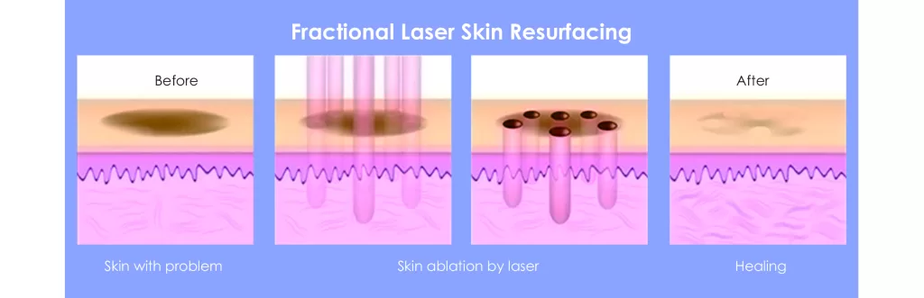 CO2 lasers remove a thin layer of skin, which results in longer downtime but dramatically improved skin remodeling.