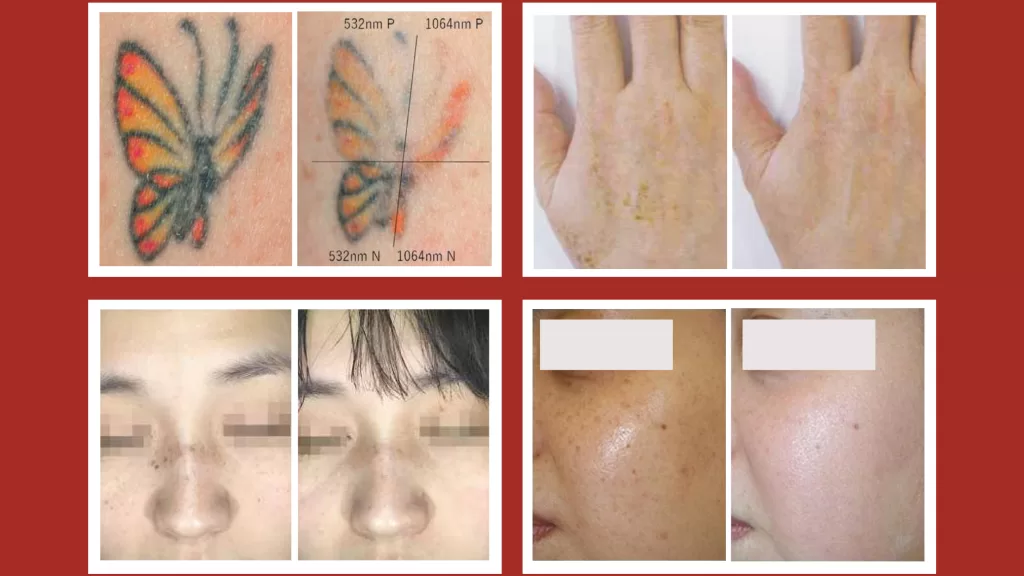 Pico laser before and after pigmentation