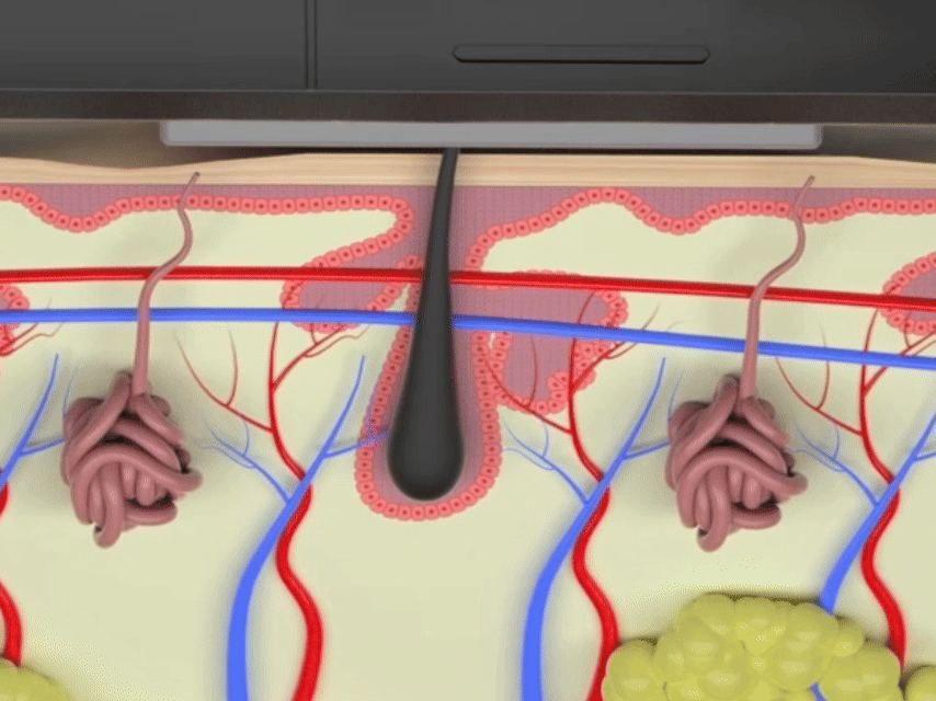 Animated demonstration of laser hair removal