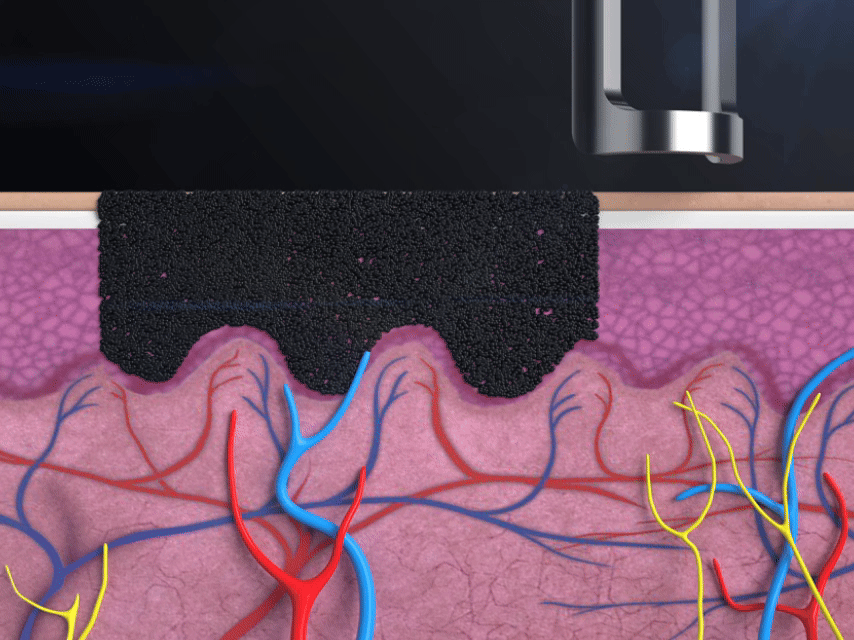 Because pico laser does not ablate the skin, the treatment is minimally invasive, and downtime is significantly reduced.