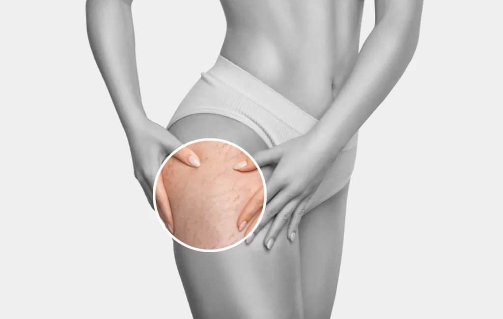 Cellulite is a structural condition of the skin and underlying tissue, not simply excess fat. The laser to treat cellulite has become a key topic among aesthetic professionals and clinic owners.