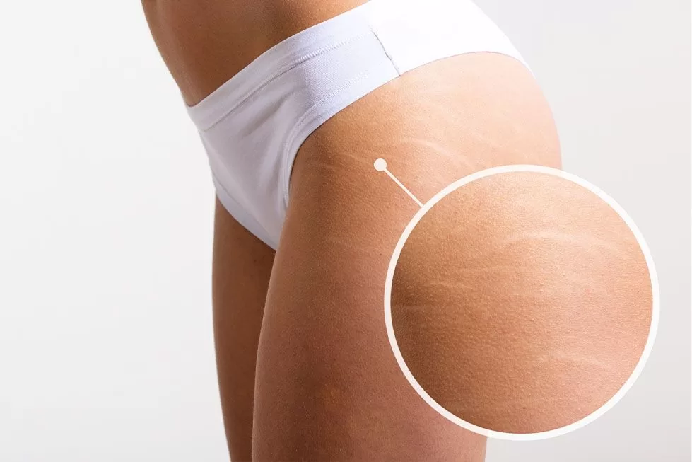 Cellulite is one of the most common aesthetic concerns worldwide. The laser to treat cellulite has become a key topic among aesthetic professionals and clinic owners.
