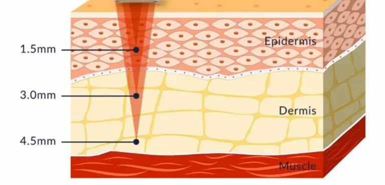 HIFU delivers focused ultrasound energy deep into the tissue to create thermal coagulation points at precise depths.