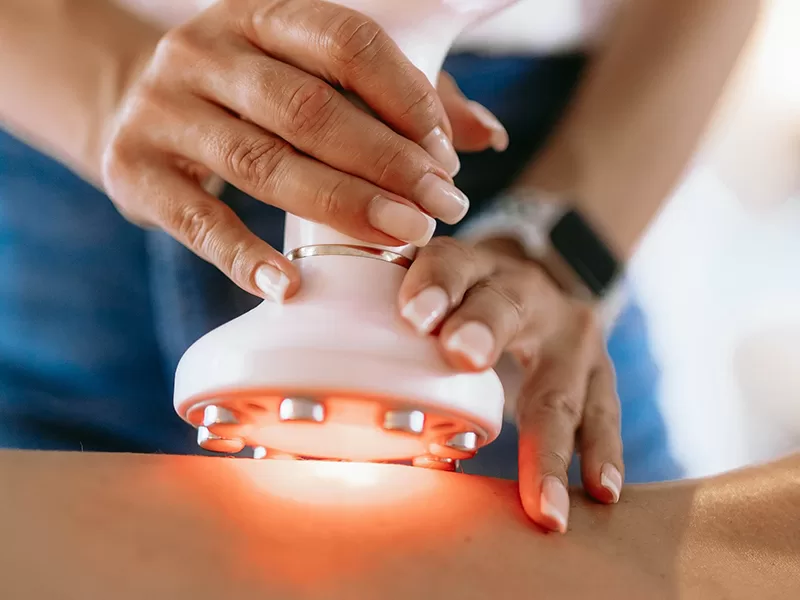 Energy-Based Technologies: Radiofrequency (RF)/ Laser to treat cellulite